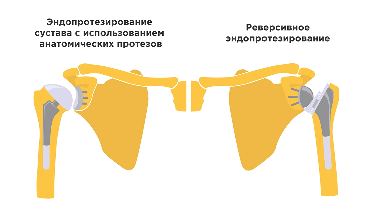 Эндопротезирование плечевого сустава